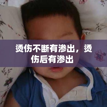 烫伤不断有渗出,烫伤后有渗出